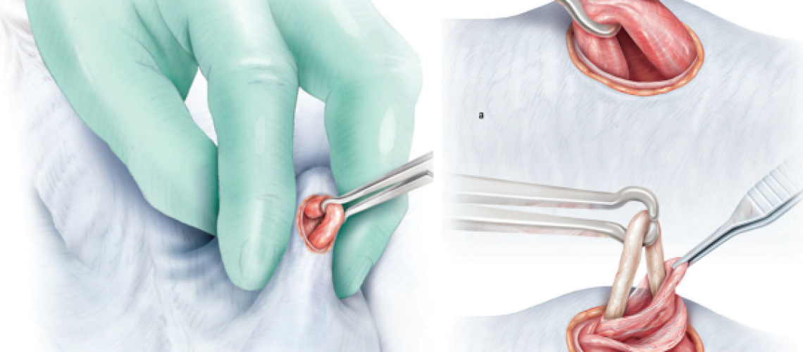 Fonte: Shergill I, et al. Surgery Illustrated – Surgical Atlas – Vasectomy illustrated. BJU Int. 2012, 10 9 , 1116–1127.