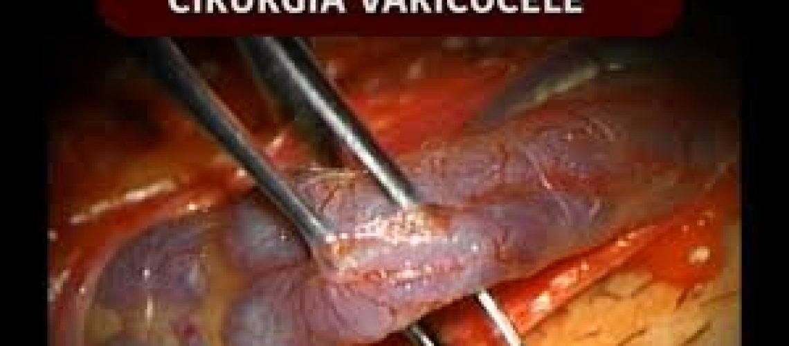 varicocele.cirurg